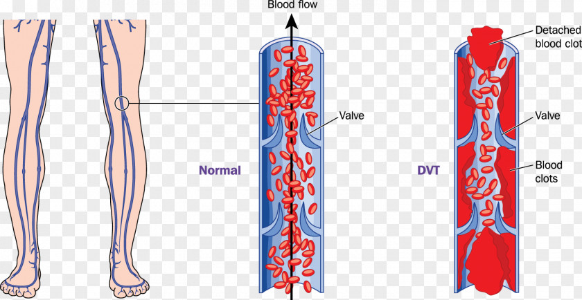 Deep Vein Thrombosis Thrombus PNG vein thrombosis Thrombus, blood clipart PNG