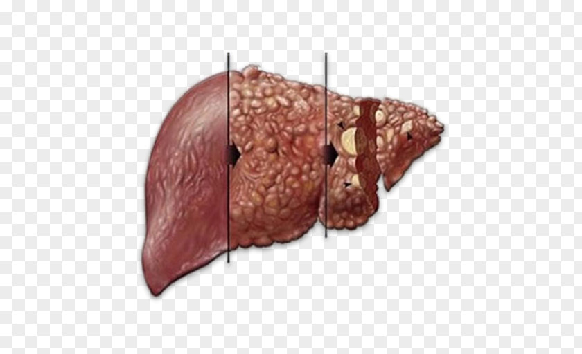 Liver Disease Hepatitis C Infectious PNG