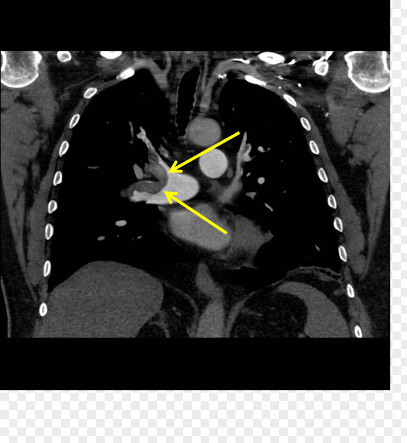 Pulmonary Artery Embolism Embolus CT Angiogram Lung PNG