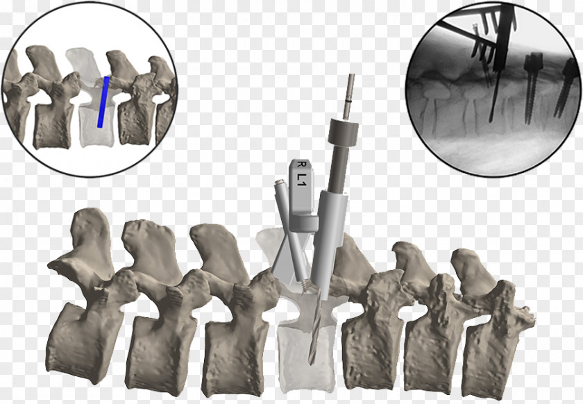 Vertebral Column Spinal Fusion Surgery Cervical Vertebrae Lumbar PNG
