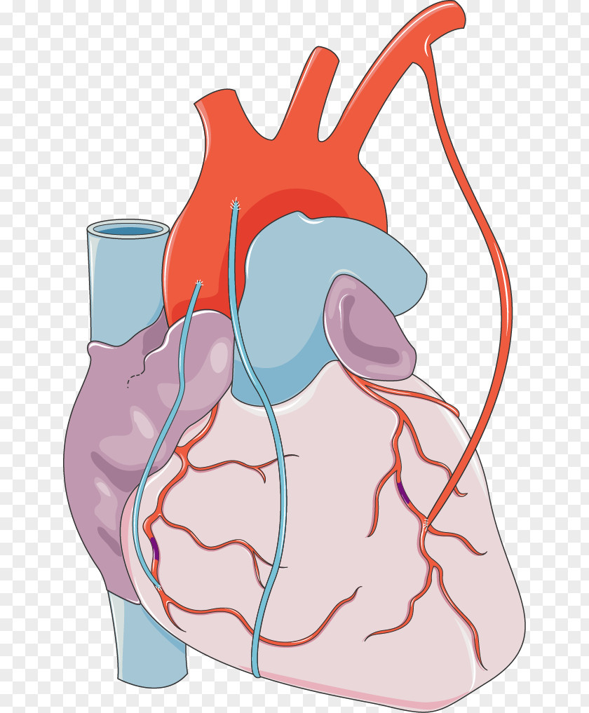 Coronary Artery Anatomy Bypass Surgery Myocardial Infarction Cardiology Arteries PNG