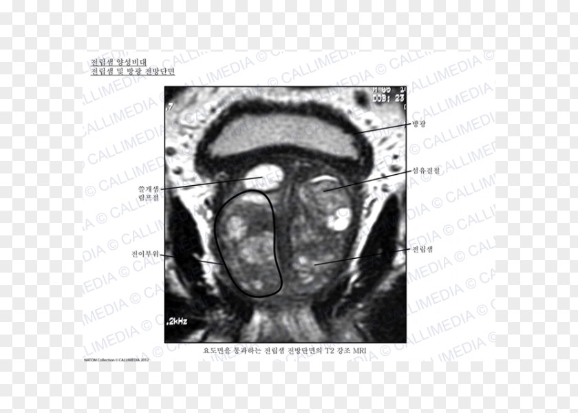Prostate Gland Urinary Bladder Urology Benign Prostatic Hyperplasia Anatomy PNG