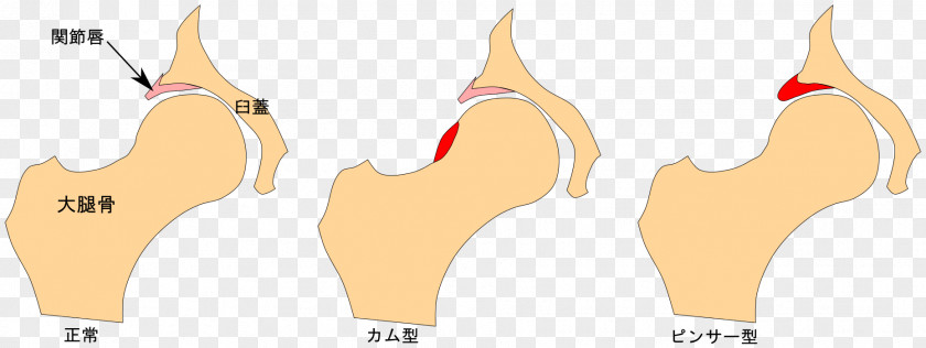 Ace Finger Femoroacetabular Impingement Hüftgelenk Acetabulum Femur PNG