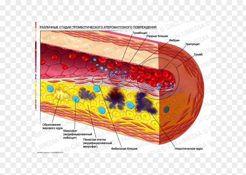 Eritrocito Atheroma Atherosclerosis Artery Stenosis Disease PNG