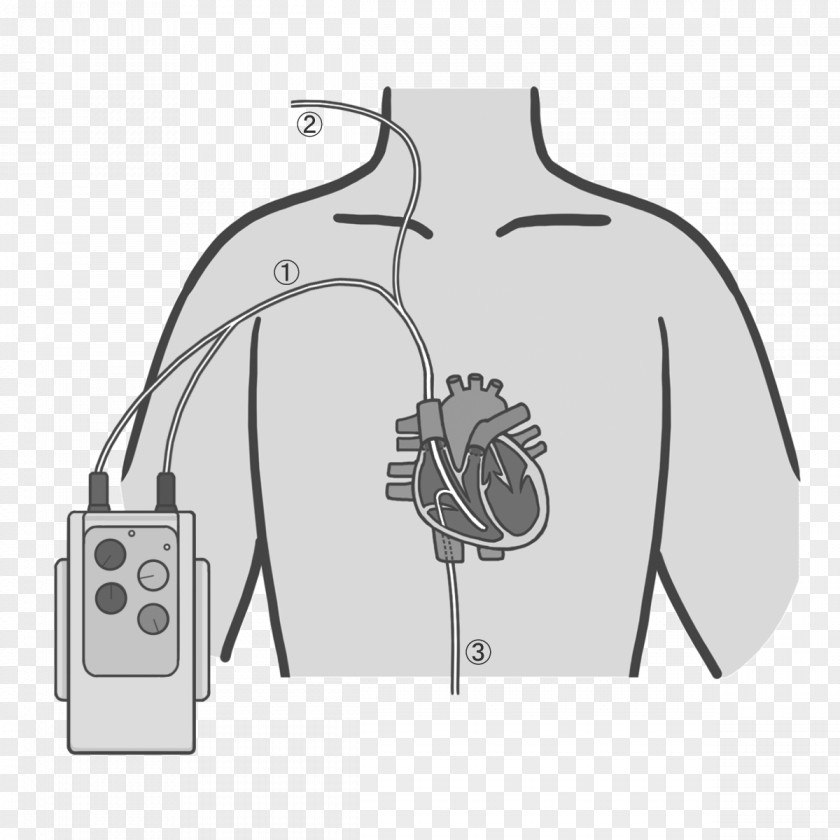 Extra Corporeal Septoplasty Artificial Cardiac Pacemaker Nursing Medical Device Illustration Automated External Defibrillators PNG