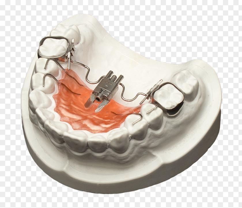 Tooth Jaw Orthodontics Orthodontic Technology Maxilla PNG