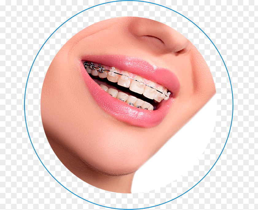 Dentistas Fluor Dental Braces Orthodontics Clear Aligners Dentistry Self-ligating Bracket PNG