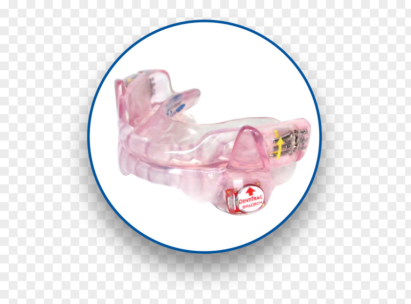 Mandibular Advancement Splints Splint Patient Sleep Apnea Bowie Positive Airway Pressure PNG