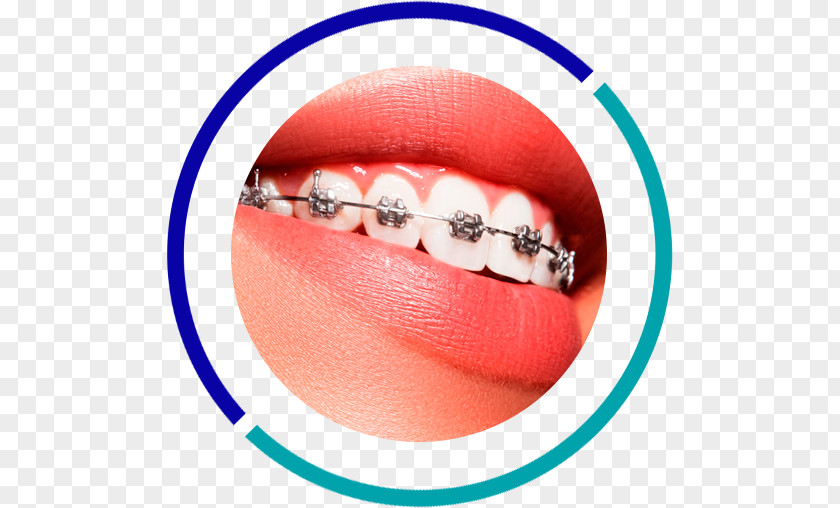 Orthodontics Dentistry Dental Braces Tooth PNG