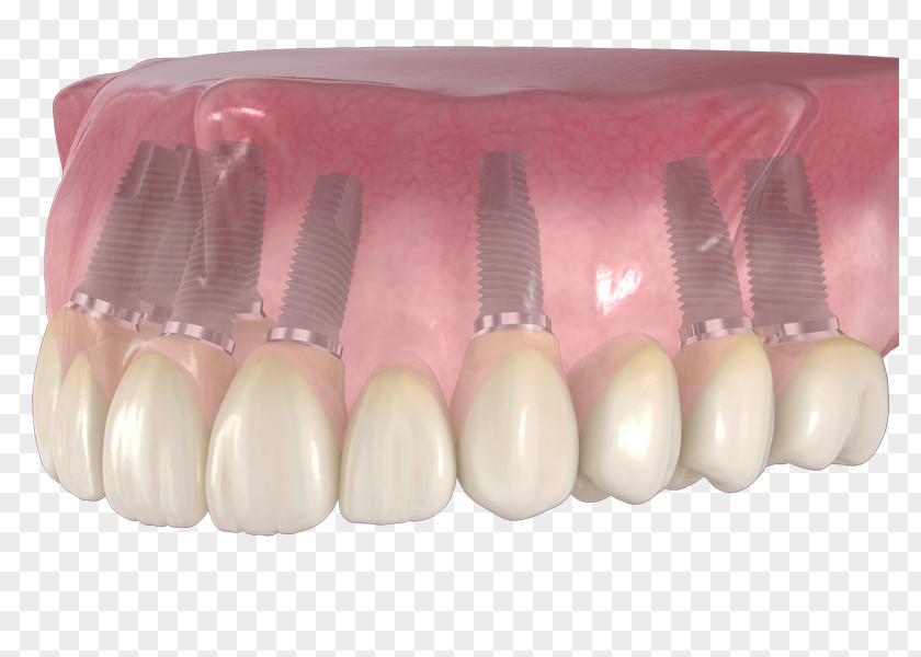 Tooth Implant Dentures Prosthesis Head Nail PNG