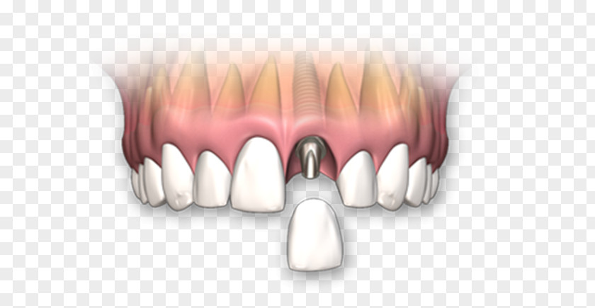 Dental Implant Dentures Dentistry Crown Human Tooth PNG