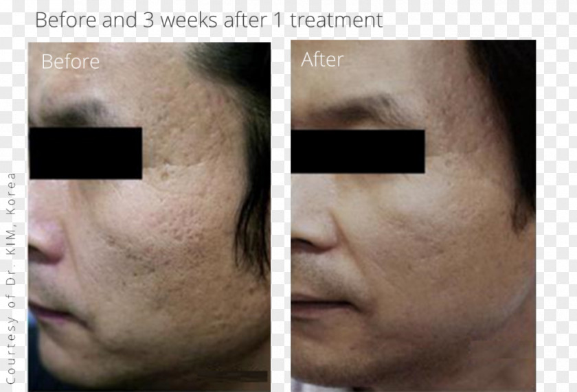 Scar Acne Cheek Surgery Wrinkle PNG