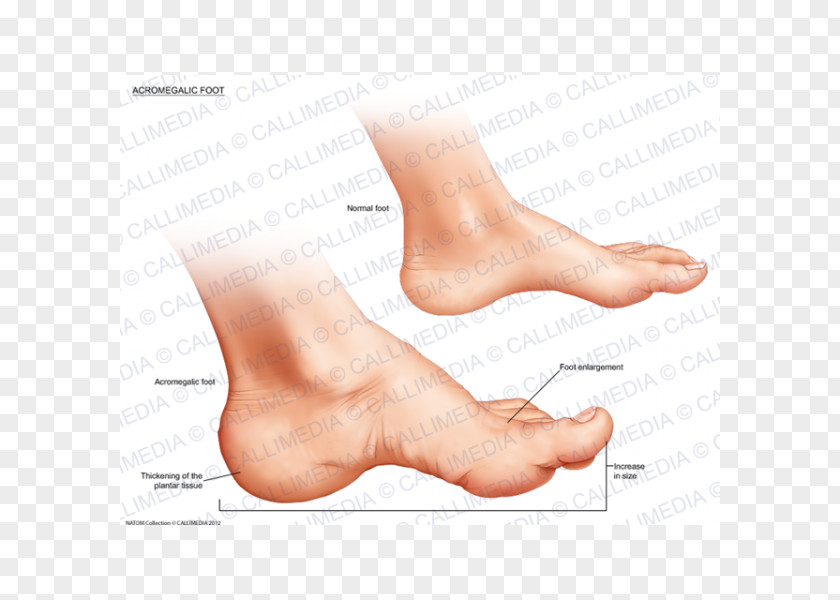 Nose Thumb Acromegaly Foot Ankle Endocrinology PNG