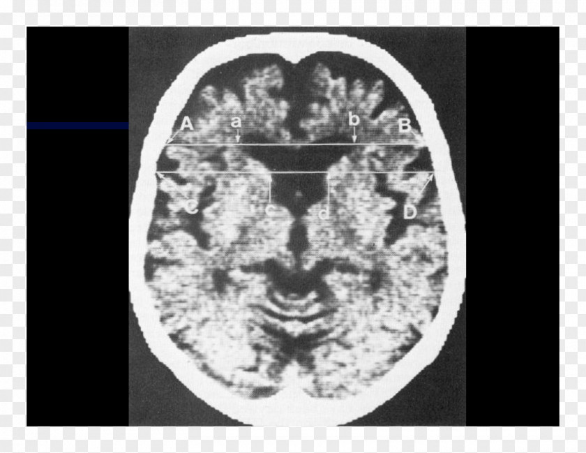 Brain Computed Tomography White Font PNG