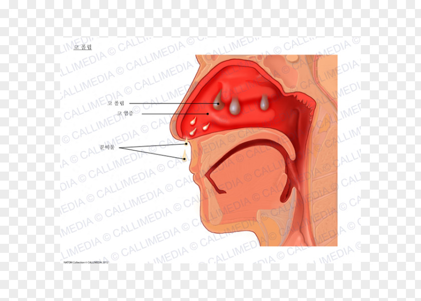 Allergy Hay Fever Nasal Polyp Rhinitis PNG