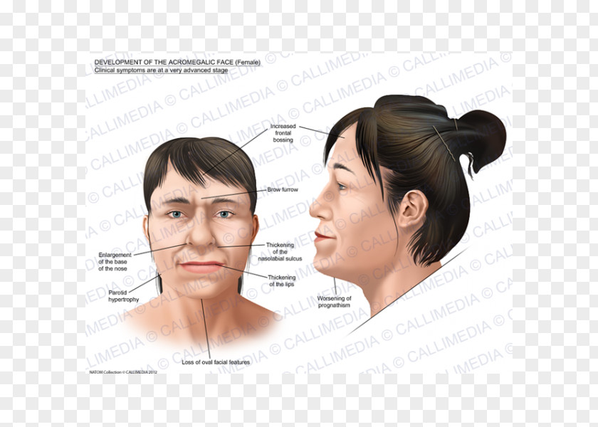 Face Acromegaly Gigantism Symptom Nose PNG