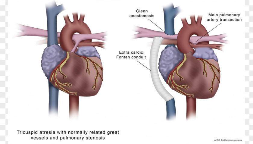 Medical Illustration Medicine Cardiology Atresia PNG