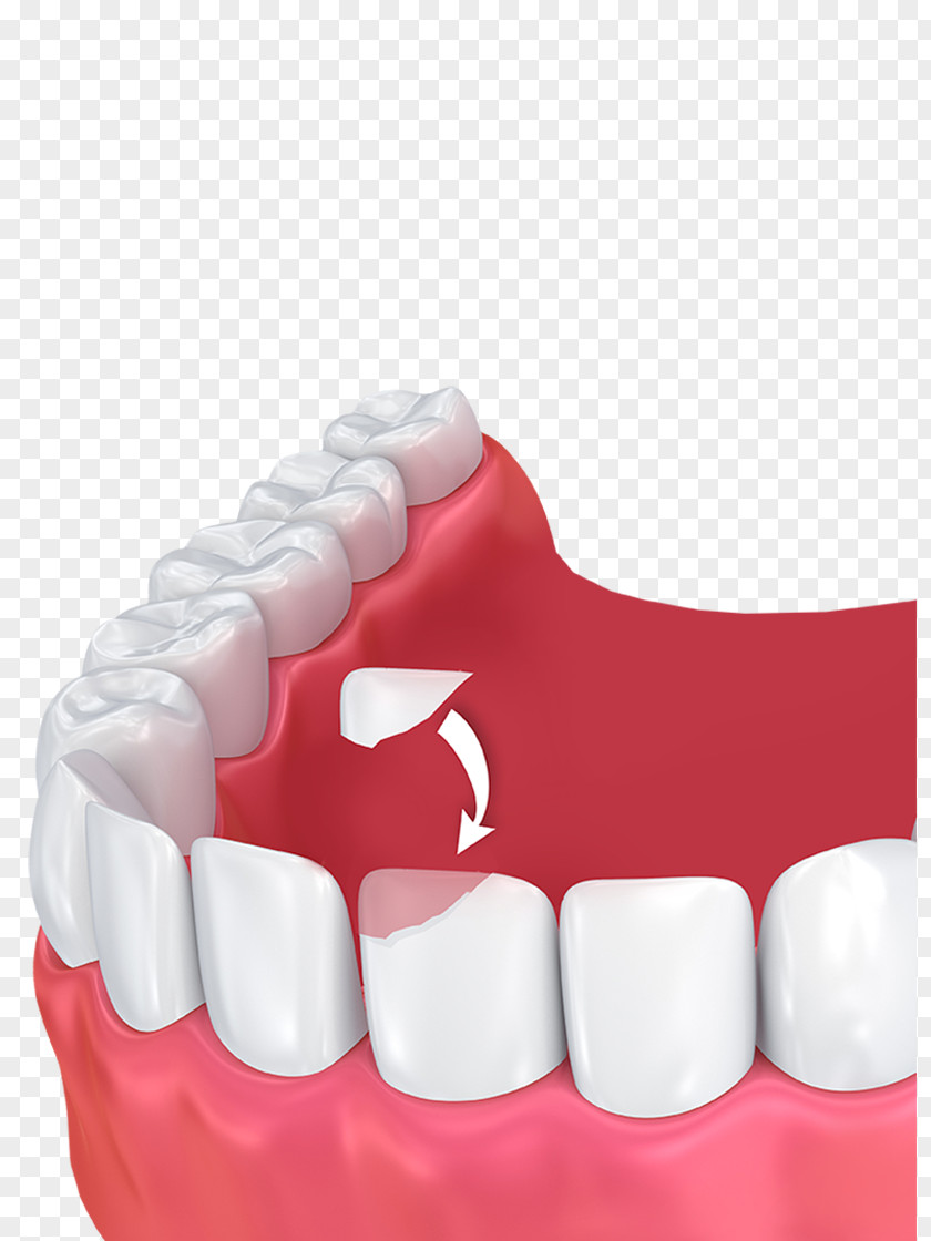 Rail Dental Human Tooth Bonding Cosmetic Dentistry PNG