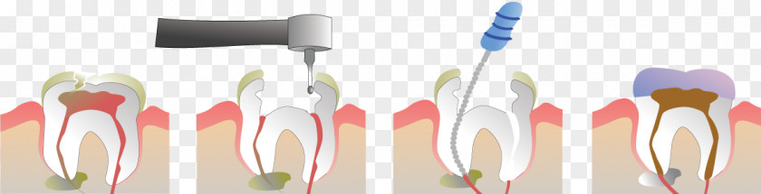 Health Endodontic Therapy Root Canal Endodontics Pulp Dentist PNG