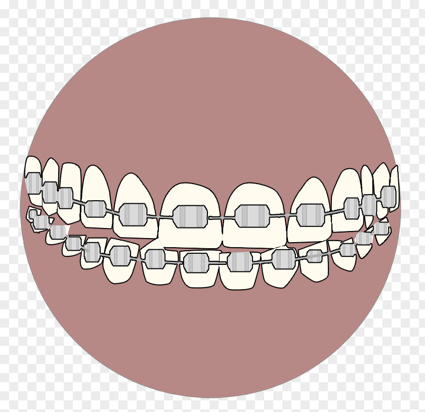 Ortho Tooth Whitening Velopex International Dental Abrasion Air-Polishing PNG