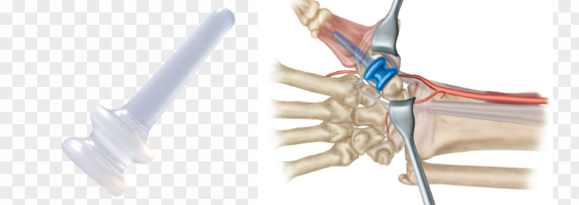 Hand Finger Interphalangeal Joints Of The Implant PNG