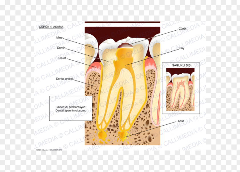 BACTERIA TOOTH Dental Abscess Tooth Brushing Dentist PNG