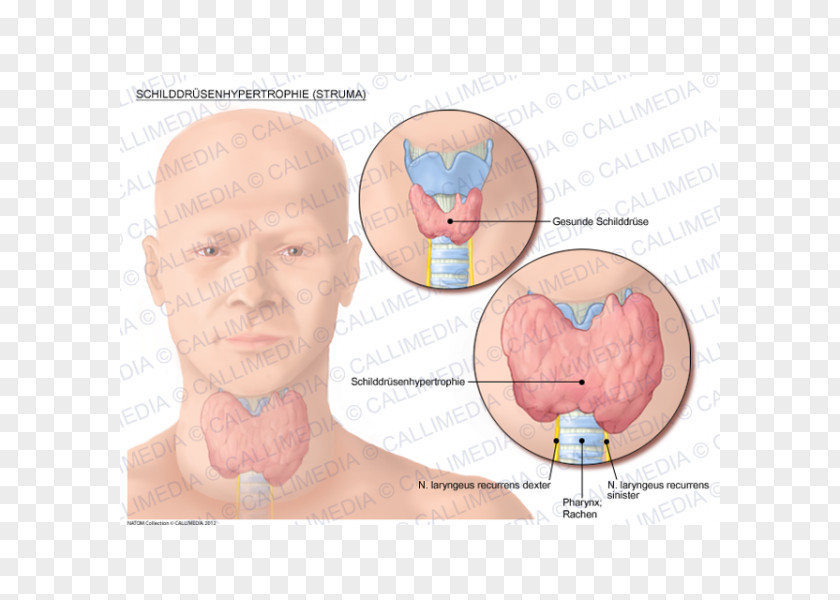 Goitre Thyroid Cancer Graves' Disease PNG