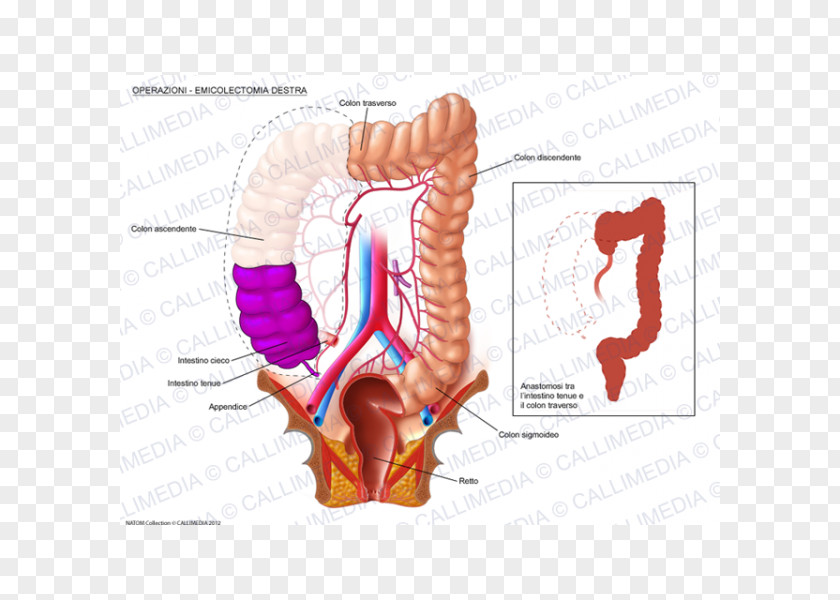 360 Degrees Colectomy Surgery Large Intestine Colorectal Cancer Human Digestive System PNG