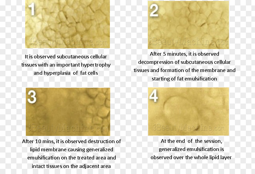 Ultrasonic Cavitation Device Ultrasound Liposuction Cellulite PNG