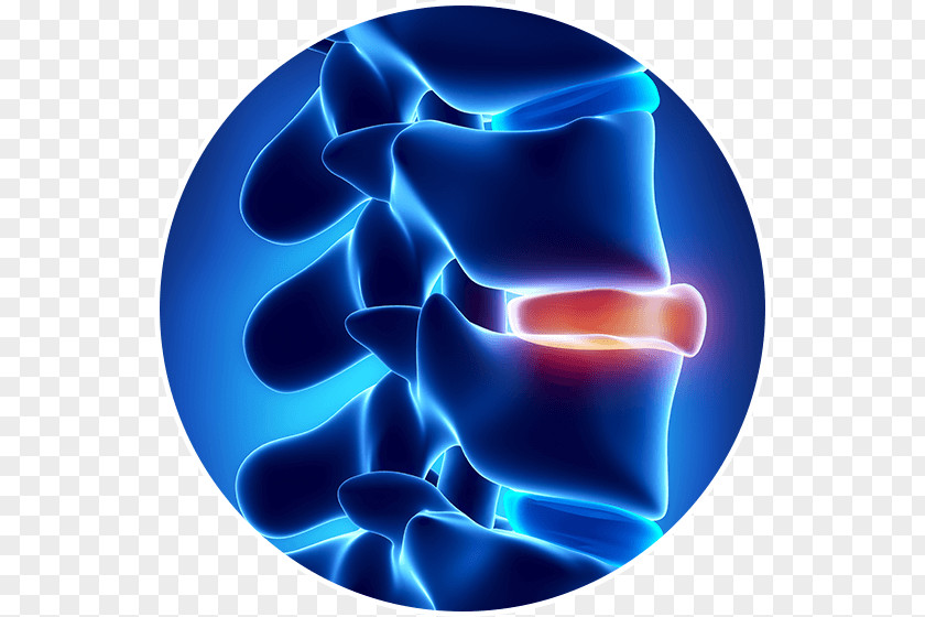 Rupture Spinal Disc Herniation Vertebral Column Intervertebral Tratamento Back Pain PNG