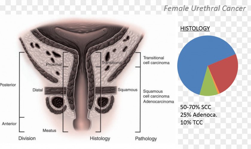 Johns Hopkins Hospital Ureteral Cancer Urethral Bladder PNG