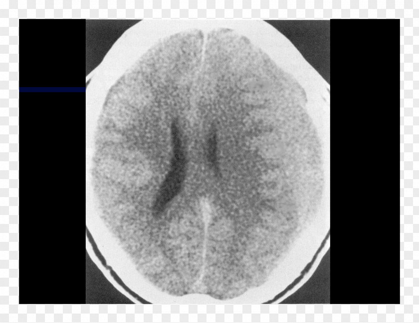 Nose Computed Tomography Lääketieteellinen Röntgenkuvaus X-ray Radiography PNG