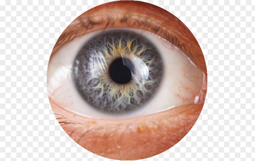 Eye Glaucoma Iridology Health Therapy PNG