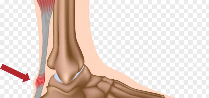 Tendon Achilles Tendinitis Tendinosis PNG