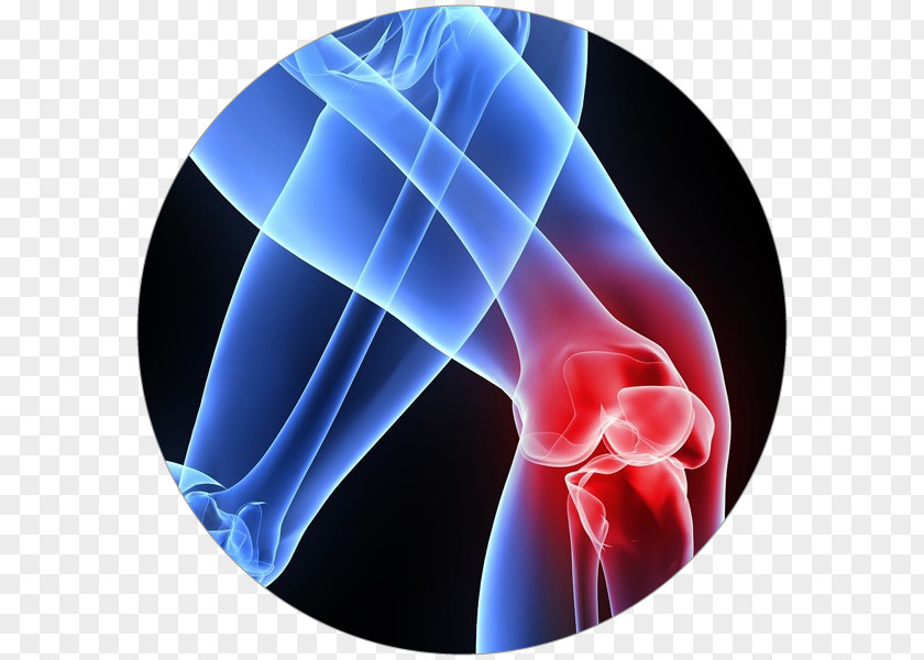 Artrosis De Rodilla Patellar Tendinitis Tendinopathy Knee Pain PNG