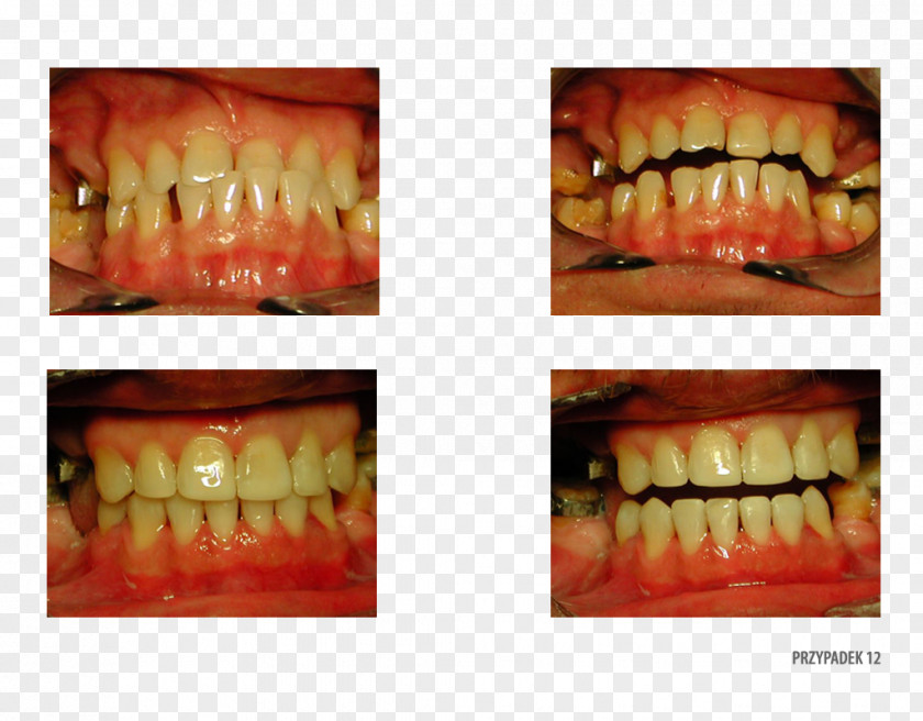 Human Tooth Gingivoplasty Gums Surgery PNG