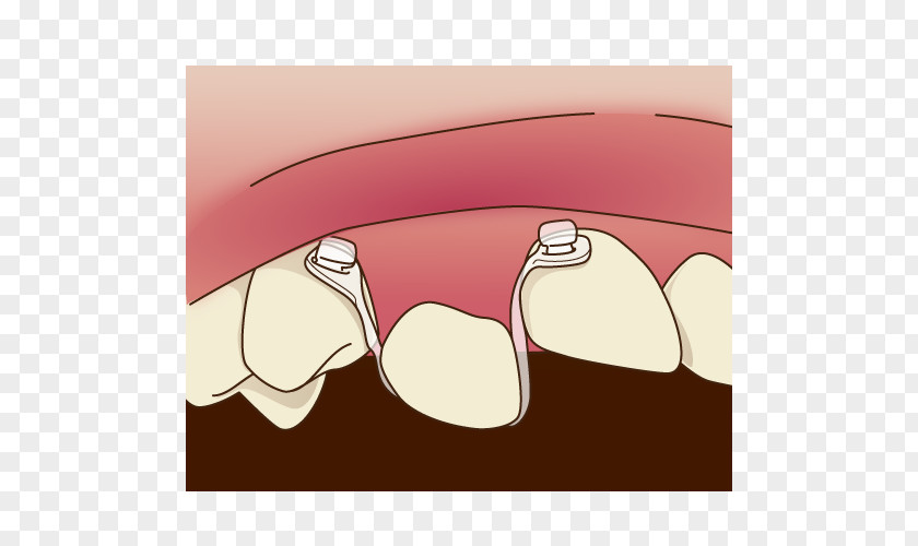 Orthodontics Tooth Dentist 矯正歯科 Dental Braces PNG