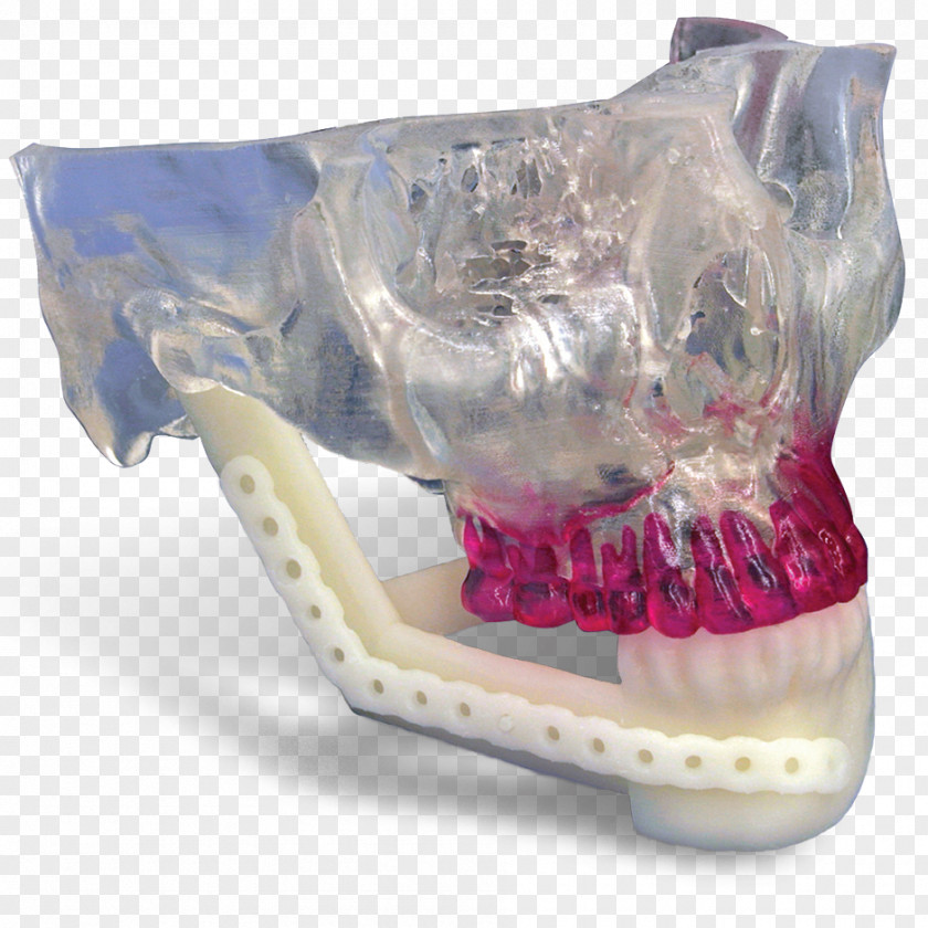 3d Printed Mandible Jaw Mandibular Reconstruction Maxilla Surgery PNG