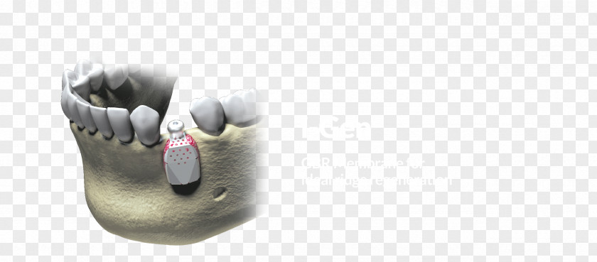 Implant Stability Quotient Dental Product Thor Shoe PNG