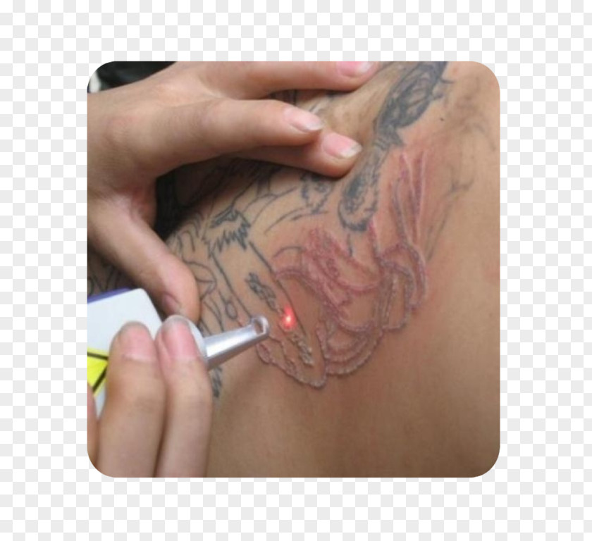 Nail Ojas Aesthetic Tattoo Removal Abziehtattoo Surgery PNG