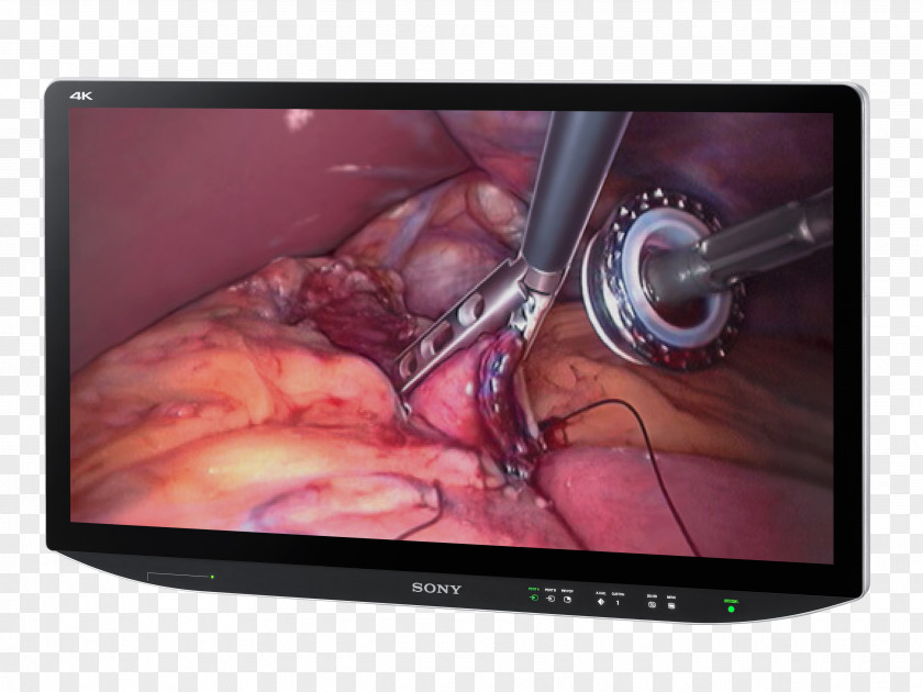 4k Resolution Wallpaper Computer Monitors Sony Corporation 4K Surgery Television PNG