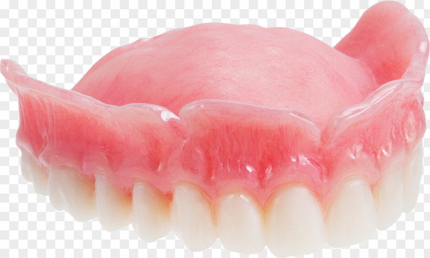 Upper Dentures Dentistry Maxilla Tooth Dental Implant PNG