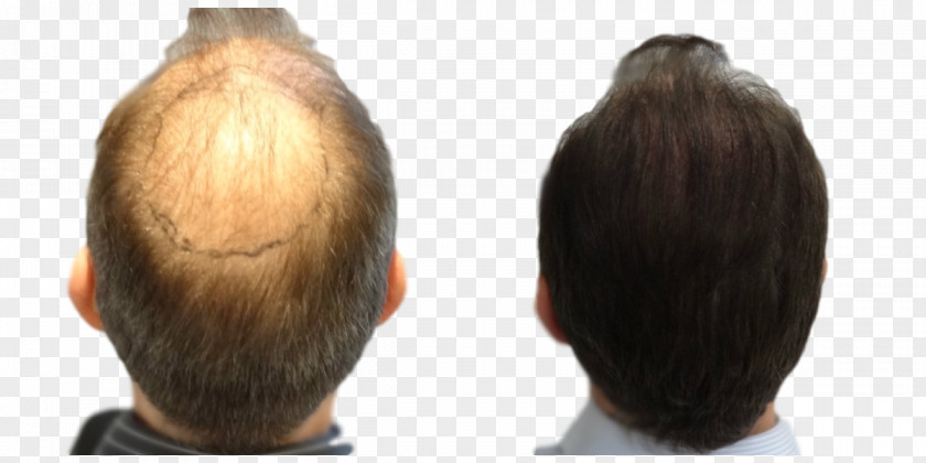 Hair Transplantation Follicular Unit Extraction Step Cutting Long PNG