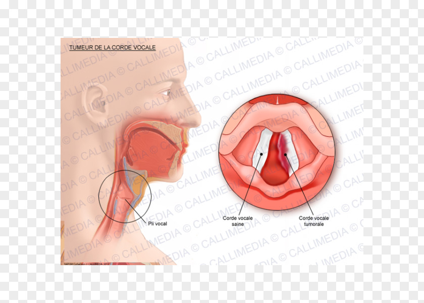 CORDE Vocal Folds Cancer Human Anatomy Vowel PNG