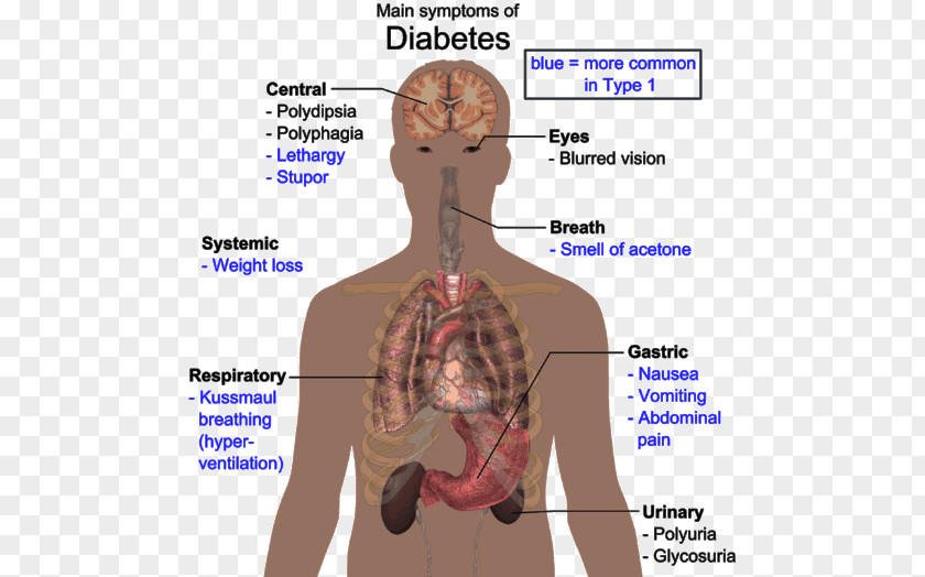 According To Dr. Diabetes Mellitus Type 2 Disease Human Body 1 PNG