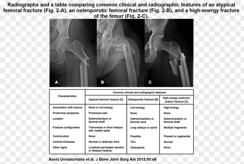 Femoral Fracture Osteoporosis Femur Bone Lisfranc Injury PNG