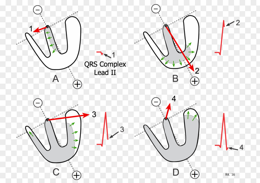 Heart QRS Complex Electrocardiography Depolarization Left Axis Deviation PNG