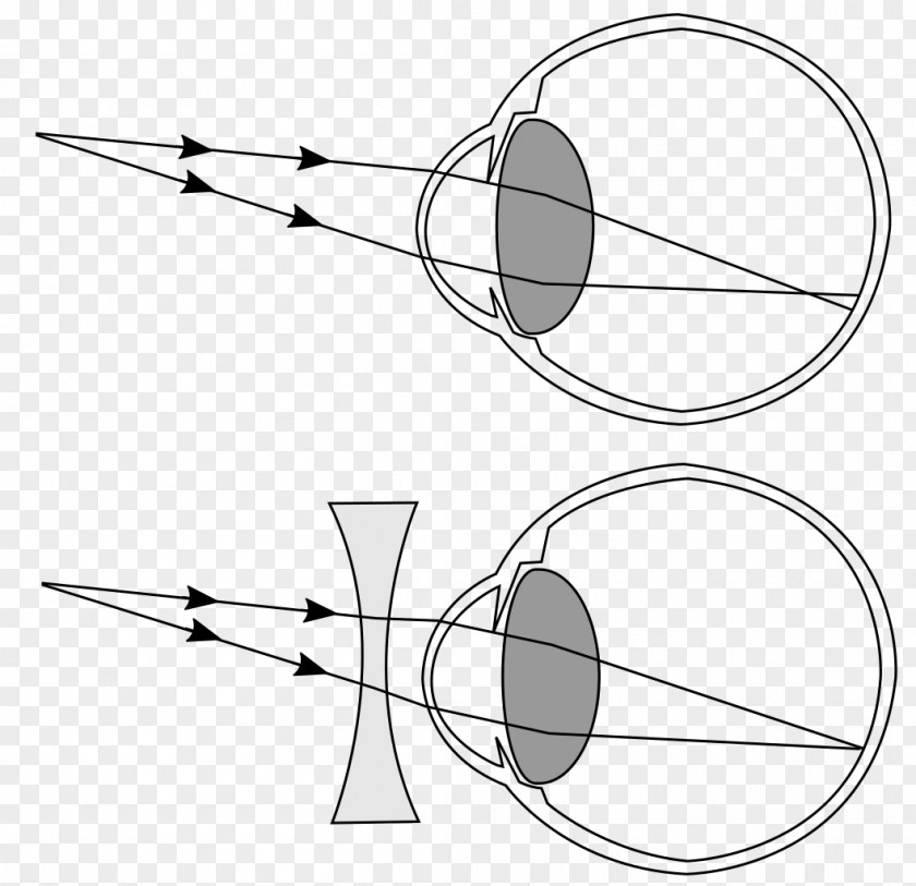 Myopia Near-sightedness Hypermetropia Refractive Error Presbyopia Eye PNG