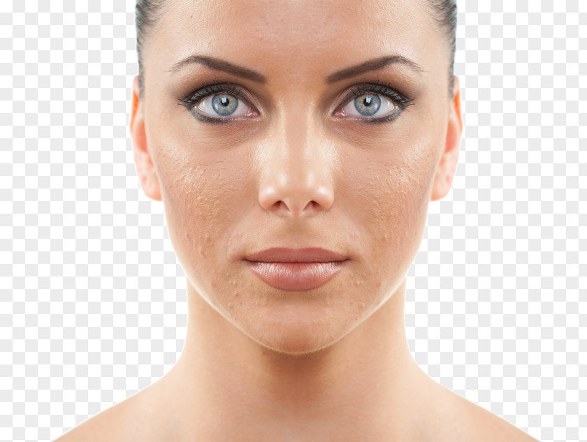 Acne Chemical Peel Exfoliation Facial Skin Photorejuvenation PNG