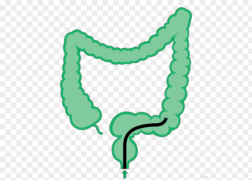 Colonoscopy Large Intestine Sigmoid Colon Descending PNG